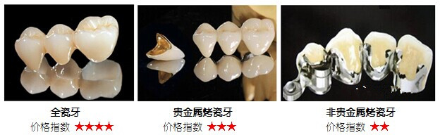 苏州虎丘区镶牙要多少钱